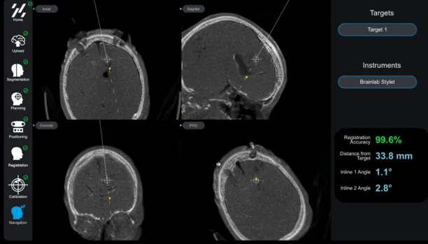 Zeta Surgical's surgery navigation assistance with computer vision.
