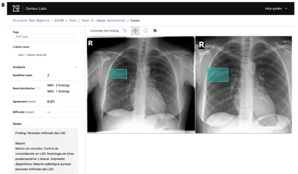 Example screenshots from PadChest-GR of annotation stages.