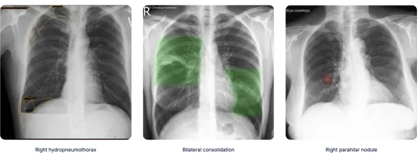 Examples from Oxipit CXR Suite on how Xray AI is used for chest X-ray analyses.