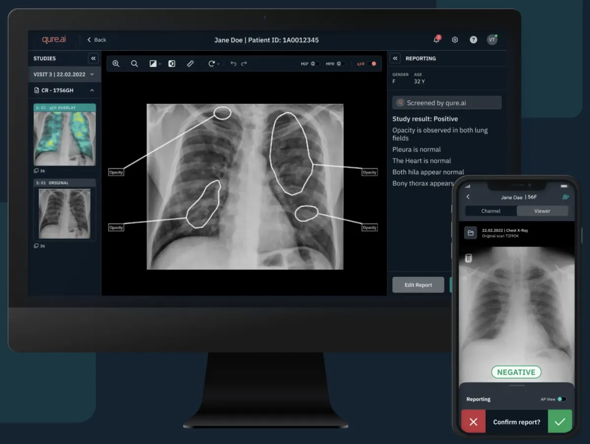 Qure.ai's mobile and desktop dashboard for chest X-ray reporting.