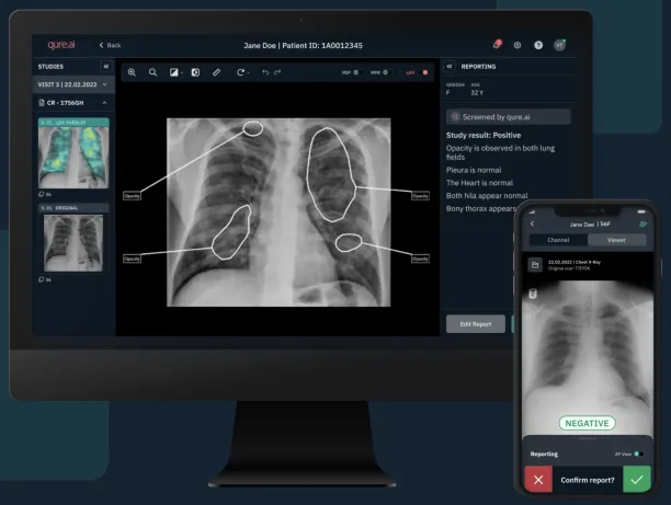Qure.ai's mobile and desktop dashboard for chest X-ray reporting.