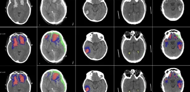 The image shows ai for neurology use cases, illustrating how AI can scan different brains.