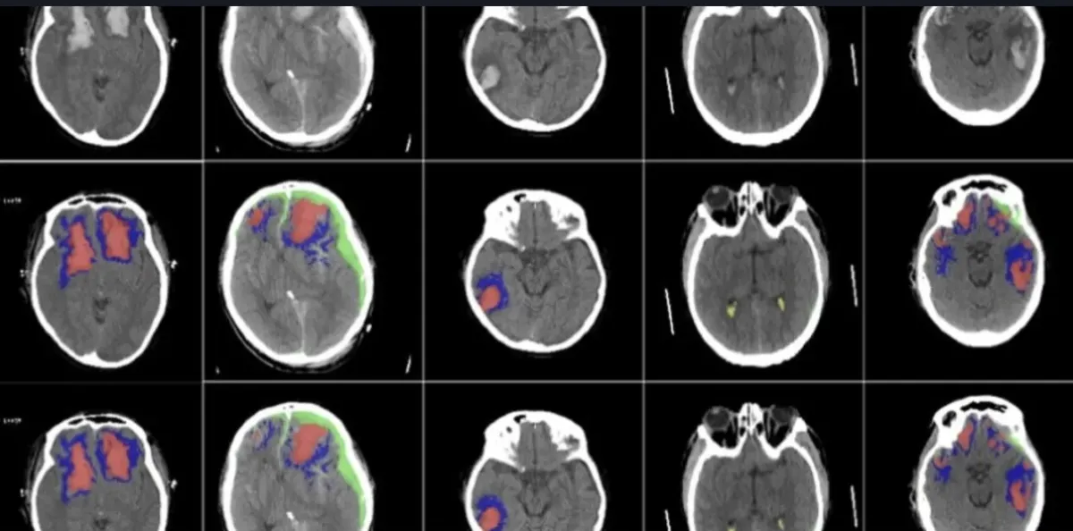 The image shows AI for neurology use cases, illustrating how AI can scan different brains.