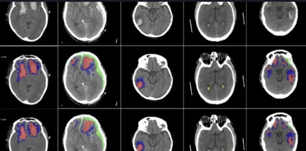 The image shows AI for neurology use cases, illustrating how AI can scan different brains.