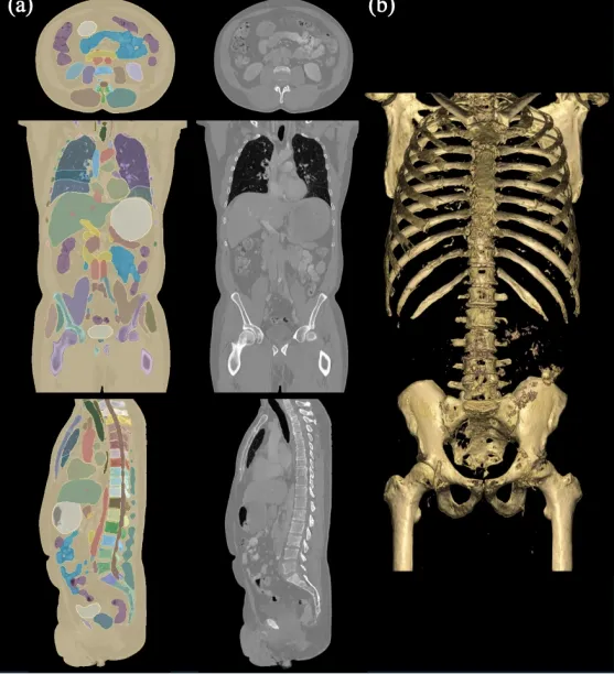 A comparison of a high-resolution CT scan generated by MAISI with its segmentation overlay, shown in axial, sagittal, and coronal views and a 3D rendering focused on bone structures, highlighting the realism of the generated scan.