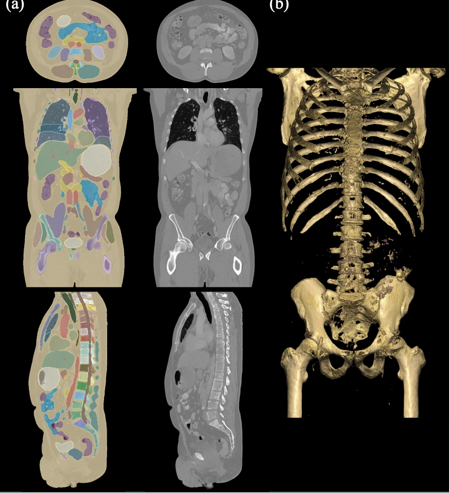 A comparison of a high-resolution CT scan generated by MAISI with its segmentation overlay, shown in axial, sagittal, and coronal views and a 3D rendering focused on bone structures, highlighting the realism of the generated scan.