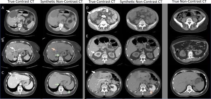 Sample CT scan images.  CycleGAN was used for data augmentation to generate generative AI data.